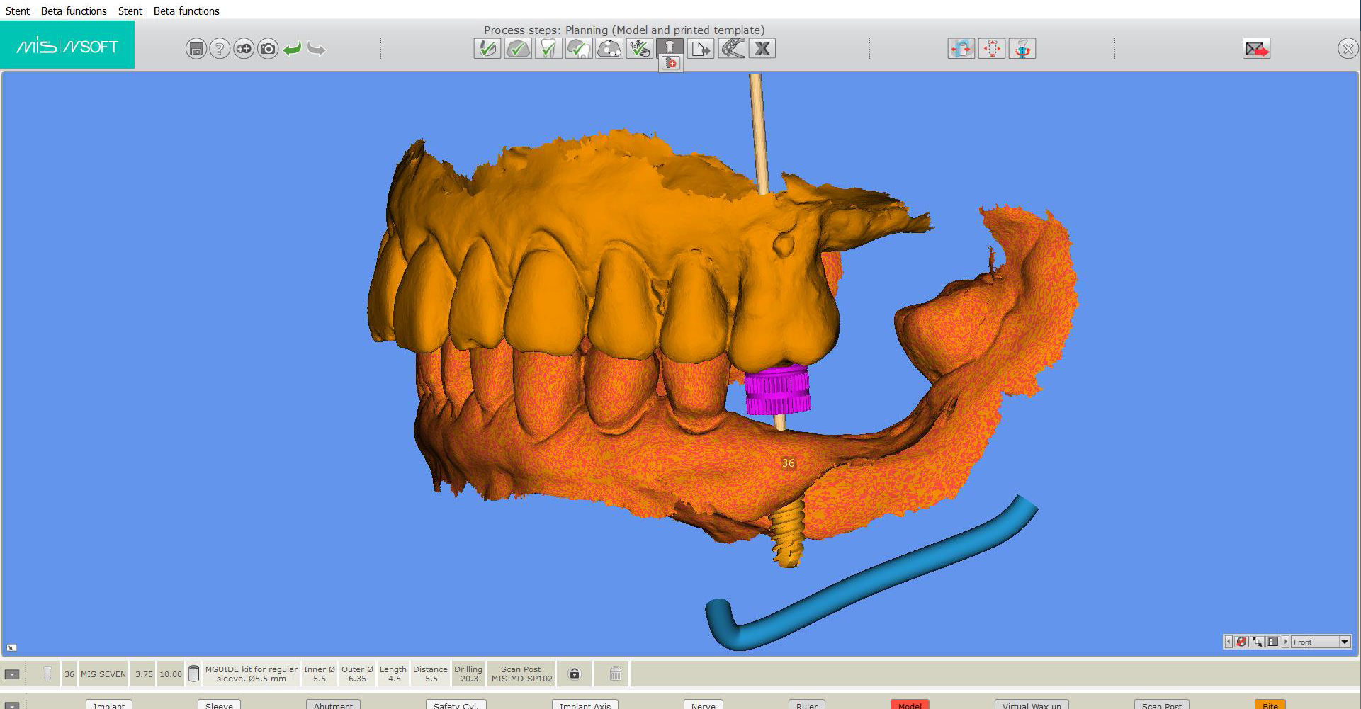 A digital dental implant visualised