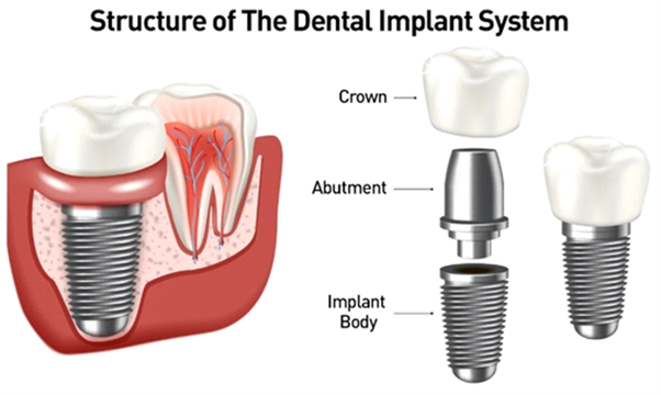 The breakdown of a dental implant system